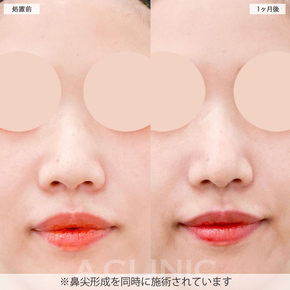 鼻先縮小術切開法症例写真