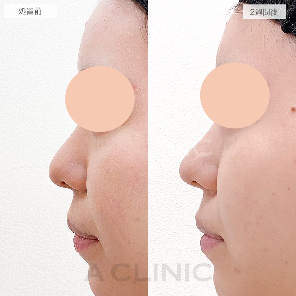 鼻先縮小術切開法症例写真