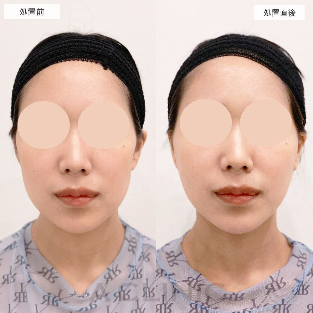 エッグフェイス症例写真