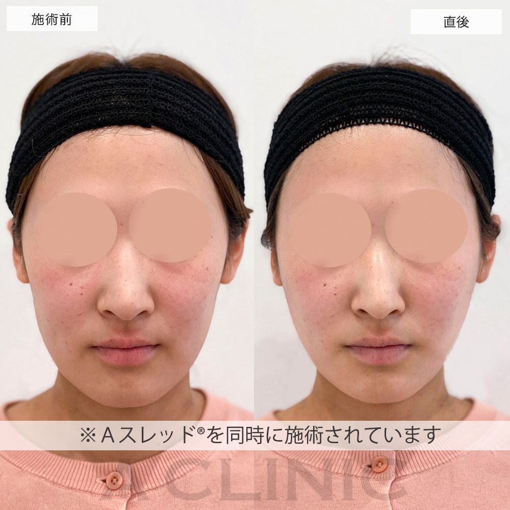 エッグフェイス症例写真