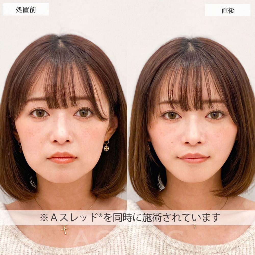 ほうれい線ヒアルロン酸<