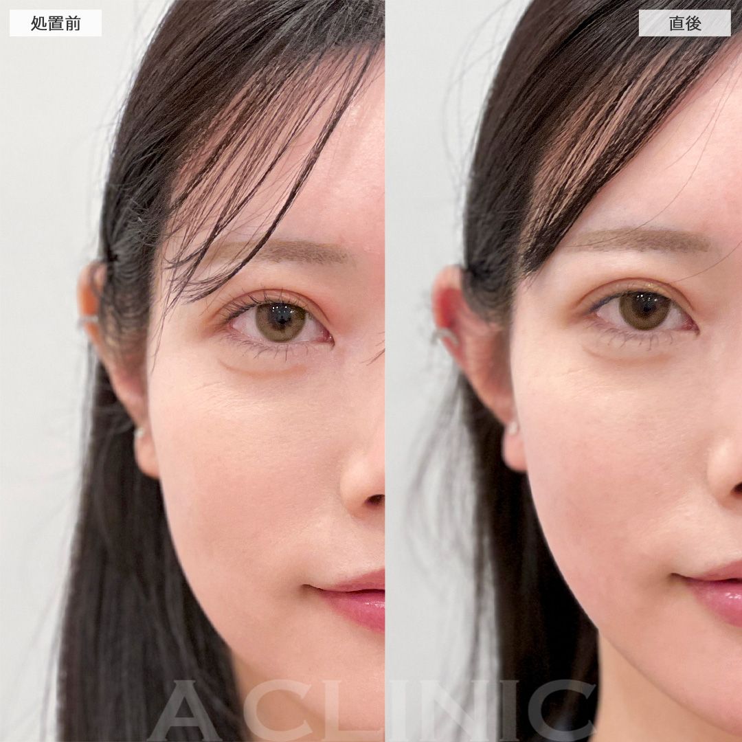 立ち耳ヒアルロン酸注入(ボリューマ)症例写真