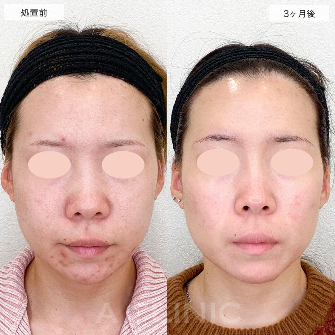 イソトレチノイン治療症例写真