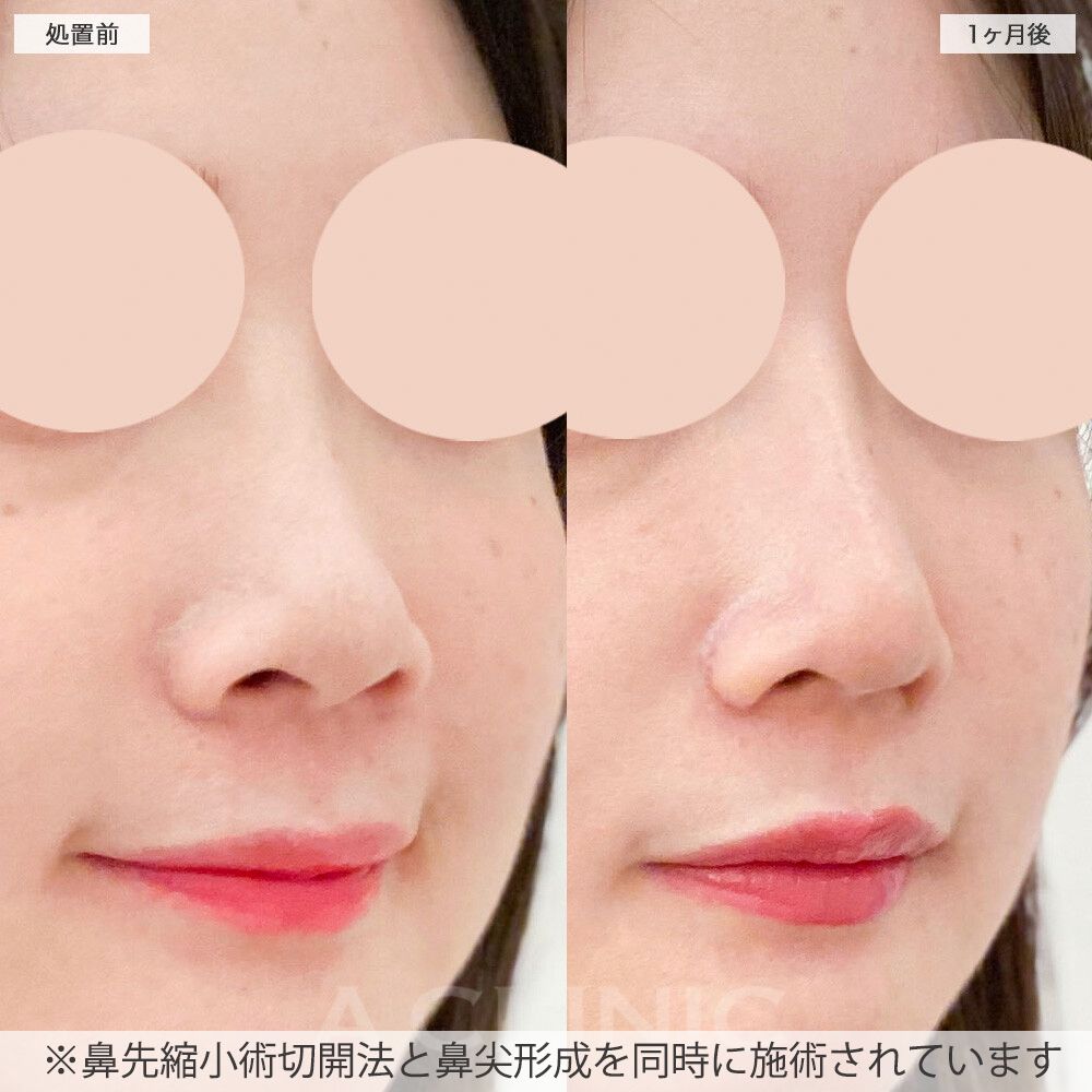 小鼻縮小術切開法症例写真