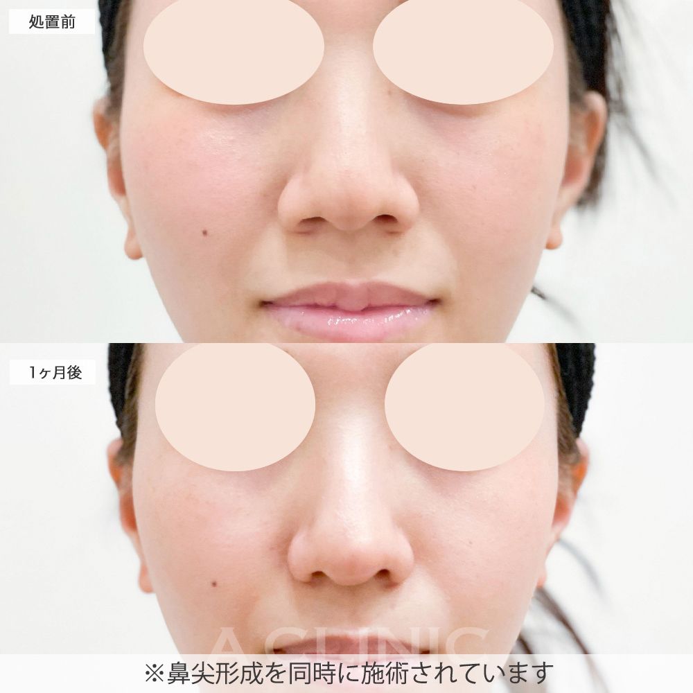 小鼻縮小術切開法症例写真