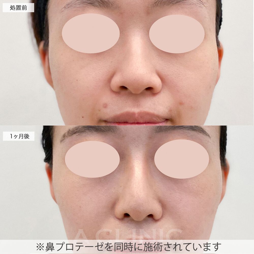 小鼻縮小術切開法症例写真