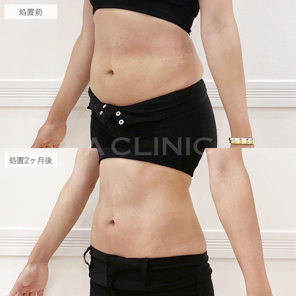 メディカルダイエット症例写真