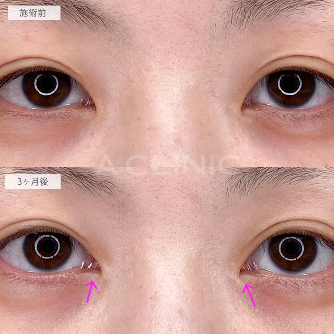 目頭切開法症例写真