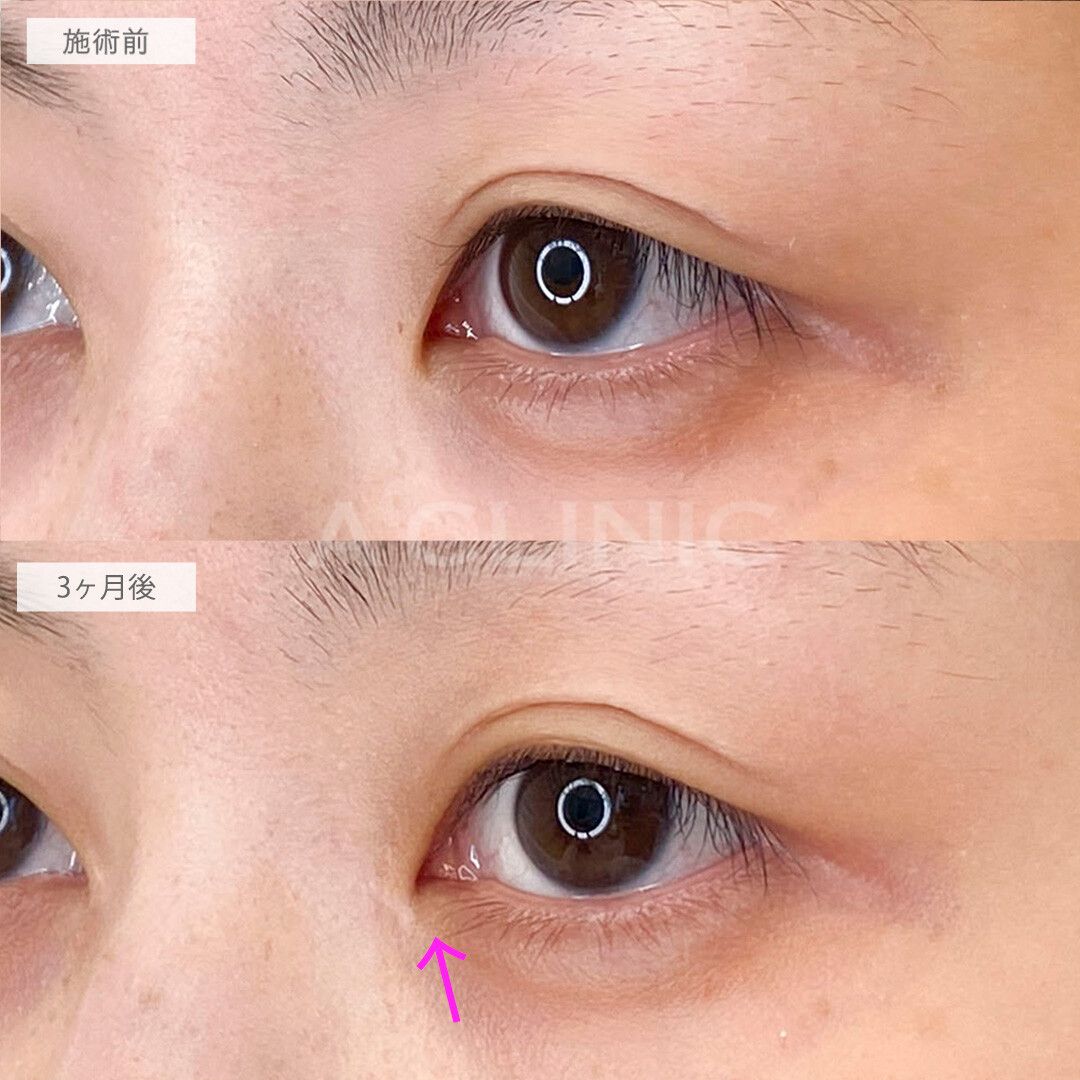 目頭切開法症例写真
