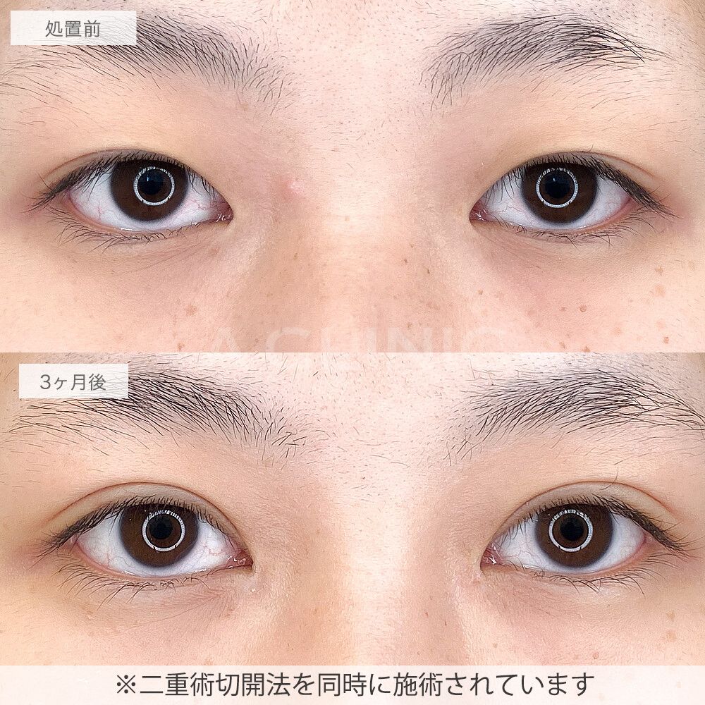 目頭切開法症例写真