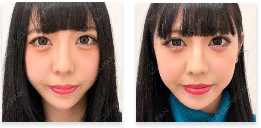 人中短縮術症例写真