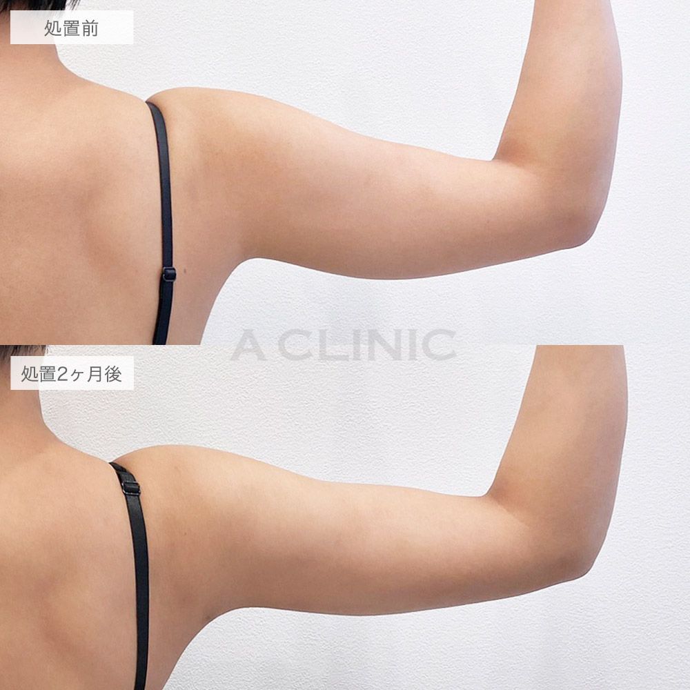 二の腕スリム脂肪吸引症例写真