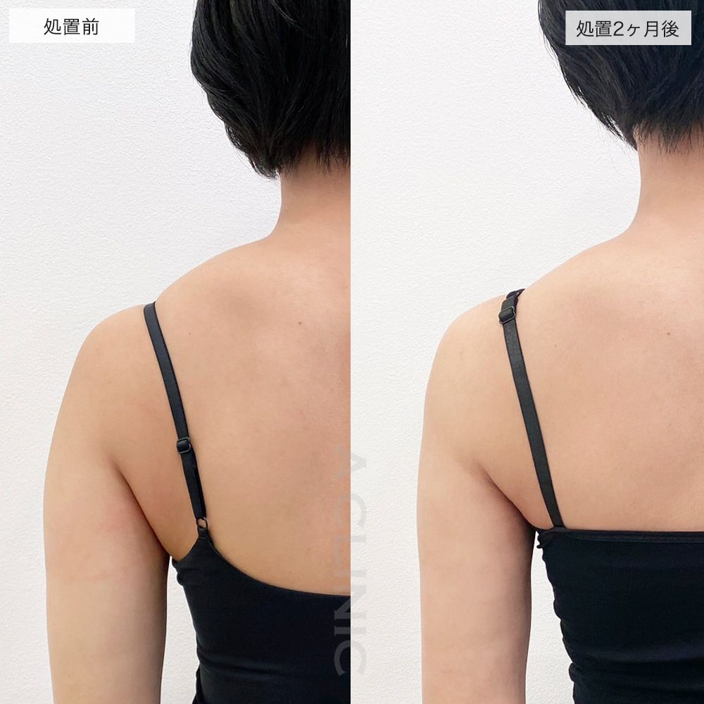 二の腕スリム脂肪吸引症例写真