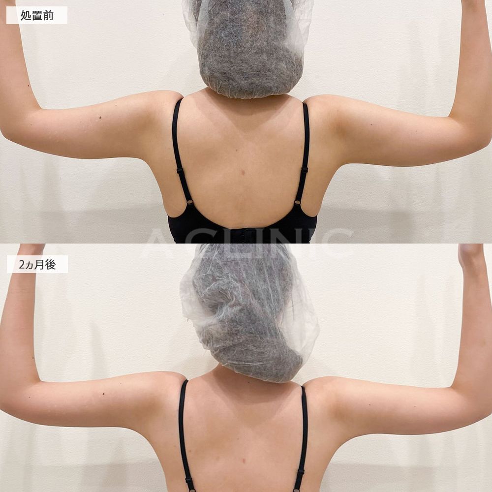 二の腕スリム脂肪吸引症例写真