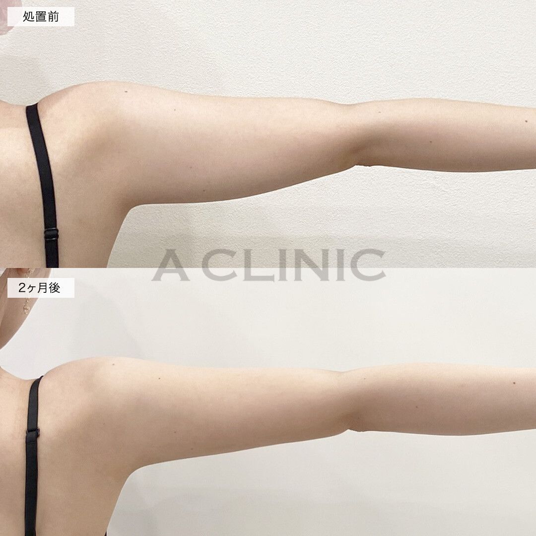 二の腕スリム脂肪吸引症例写真