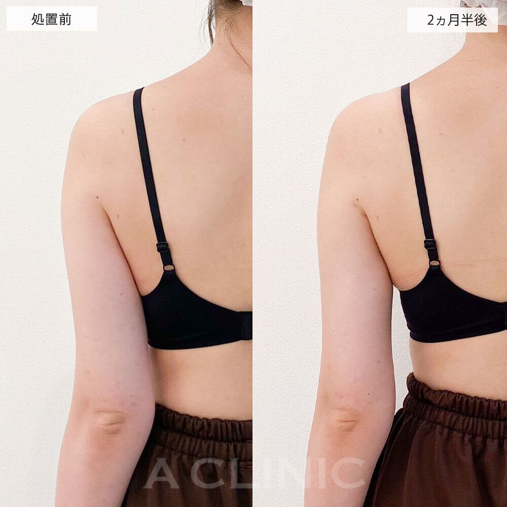二の腕スリム脂肪吸引症例写真