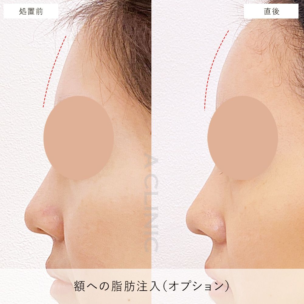 二の腕スリム脂肪注入例写真