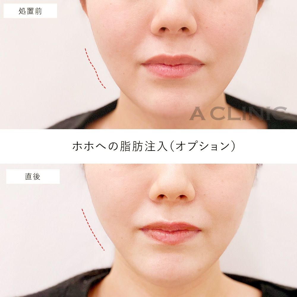 二の腕スリム脂肪注入症例写真