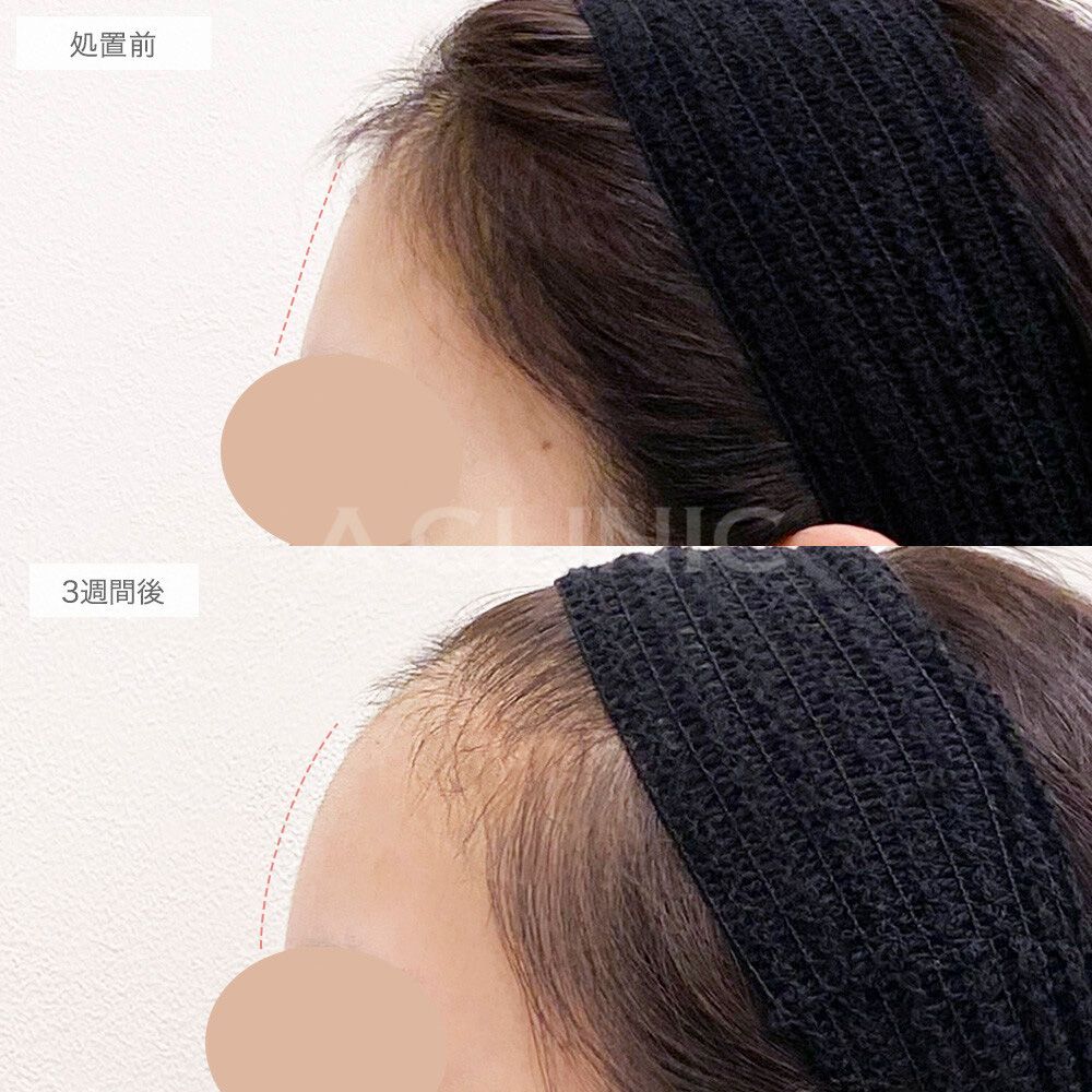 二の腕スリム脂肪注入例写真