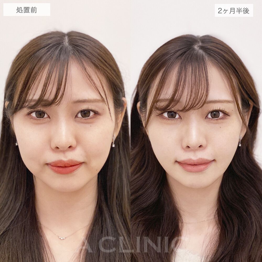 1day小顔脂肪吸引症例写真