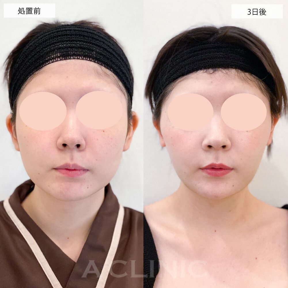 1day小顔脂肪吸引症例写真