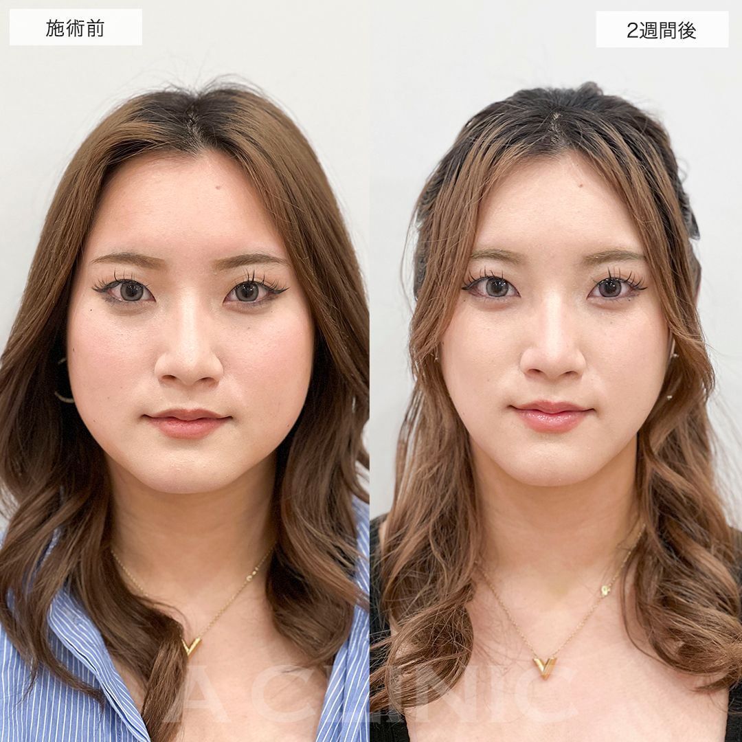 1day小顔脂肪吸引症例写真
