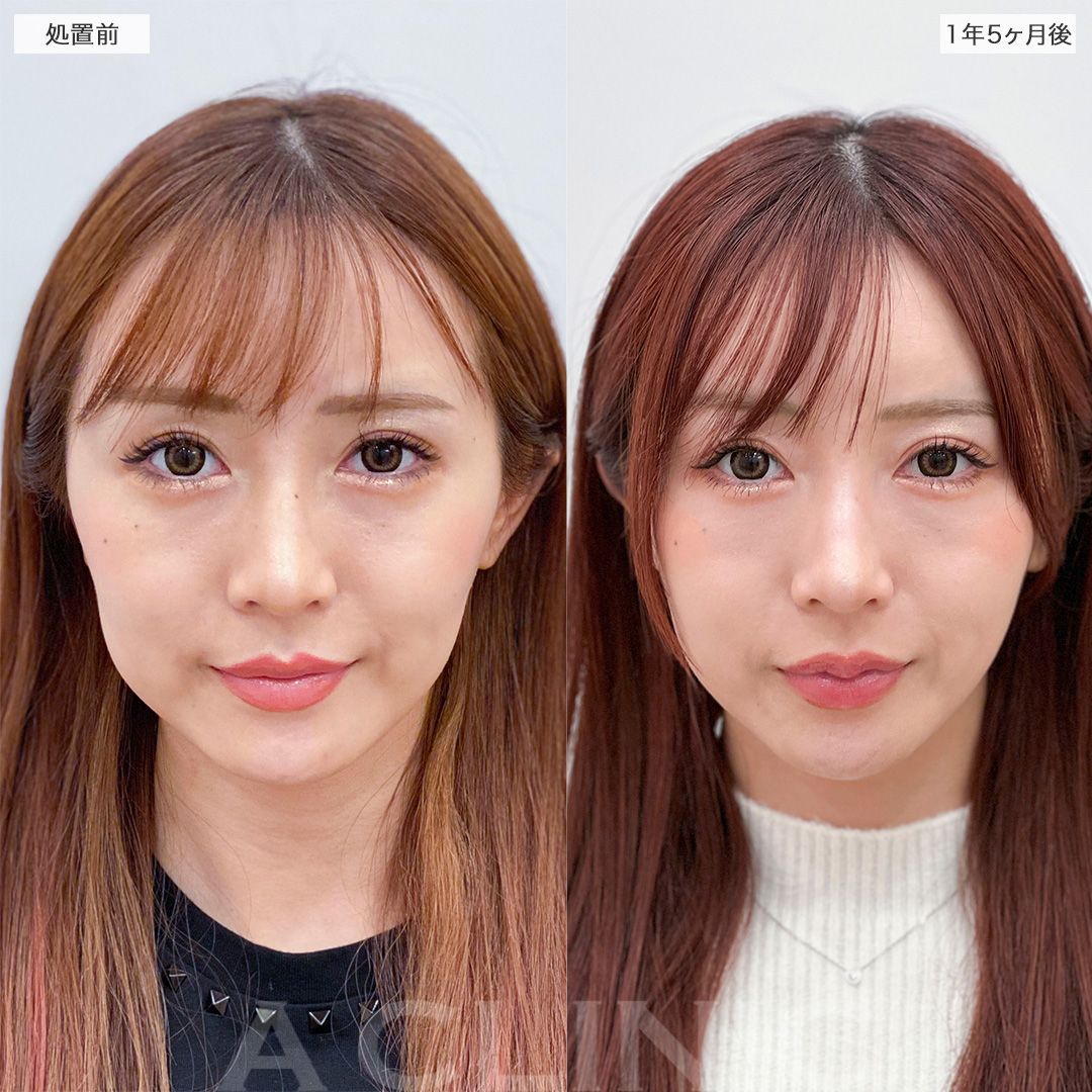 1day小顔脂肪吸引症例写真