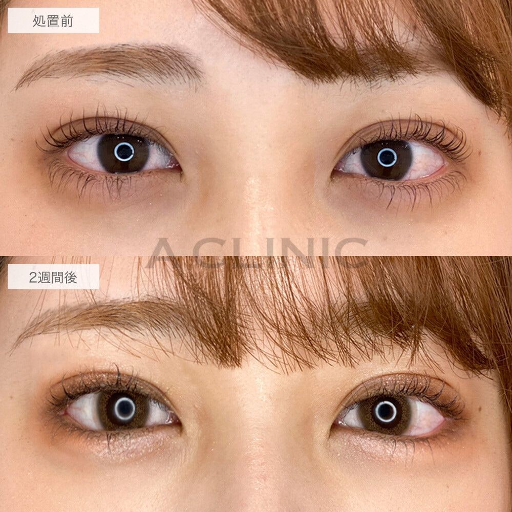 パーフェクトアイズ®︎症例写真