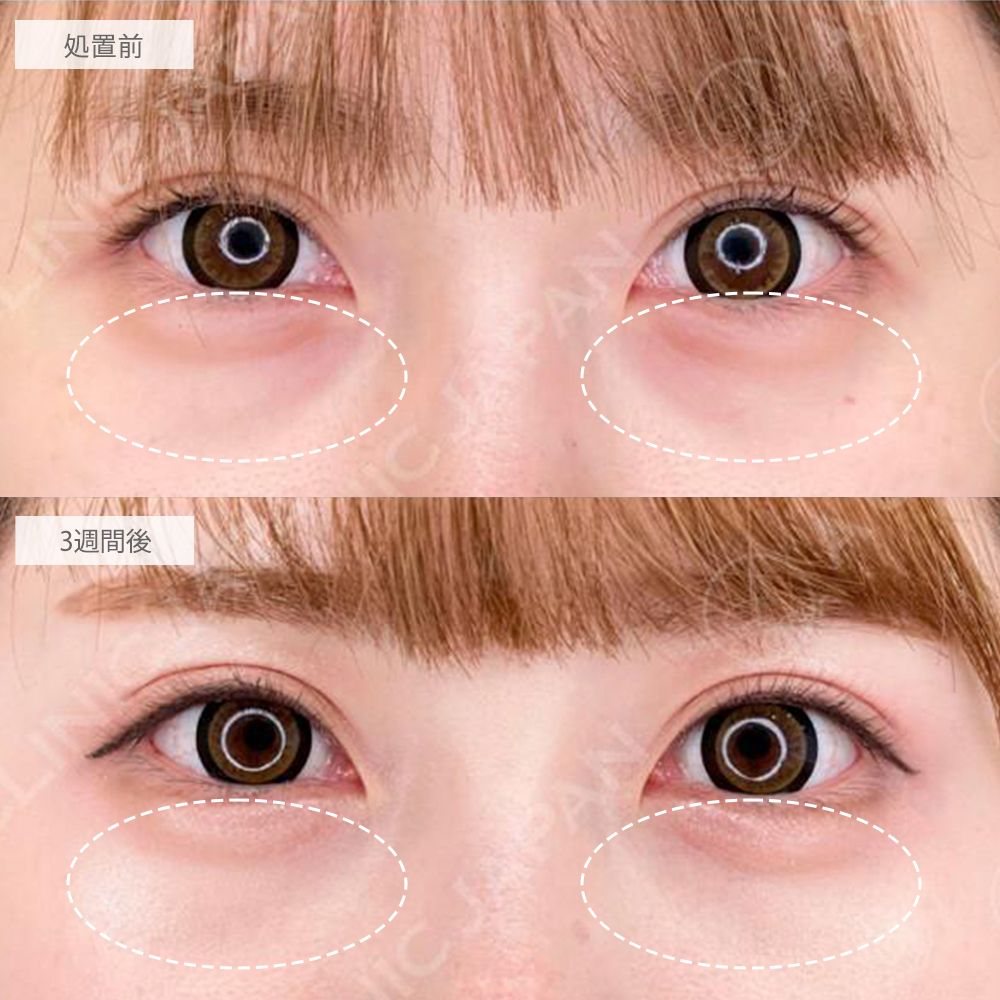 PRP血小板療法症例写真