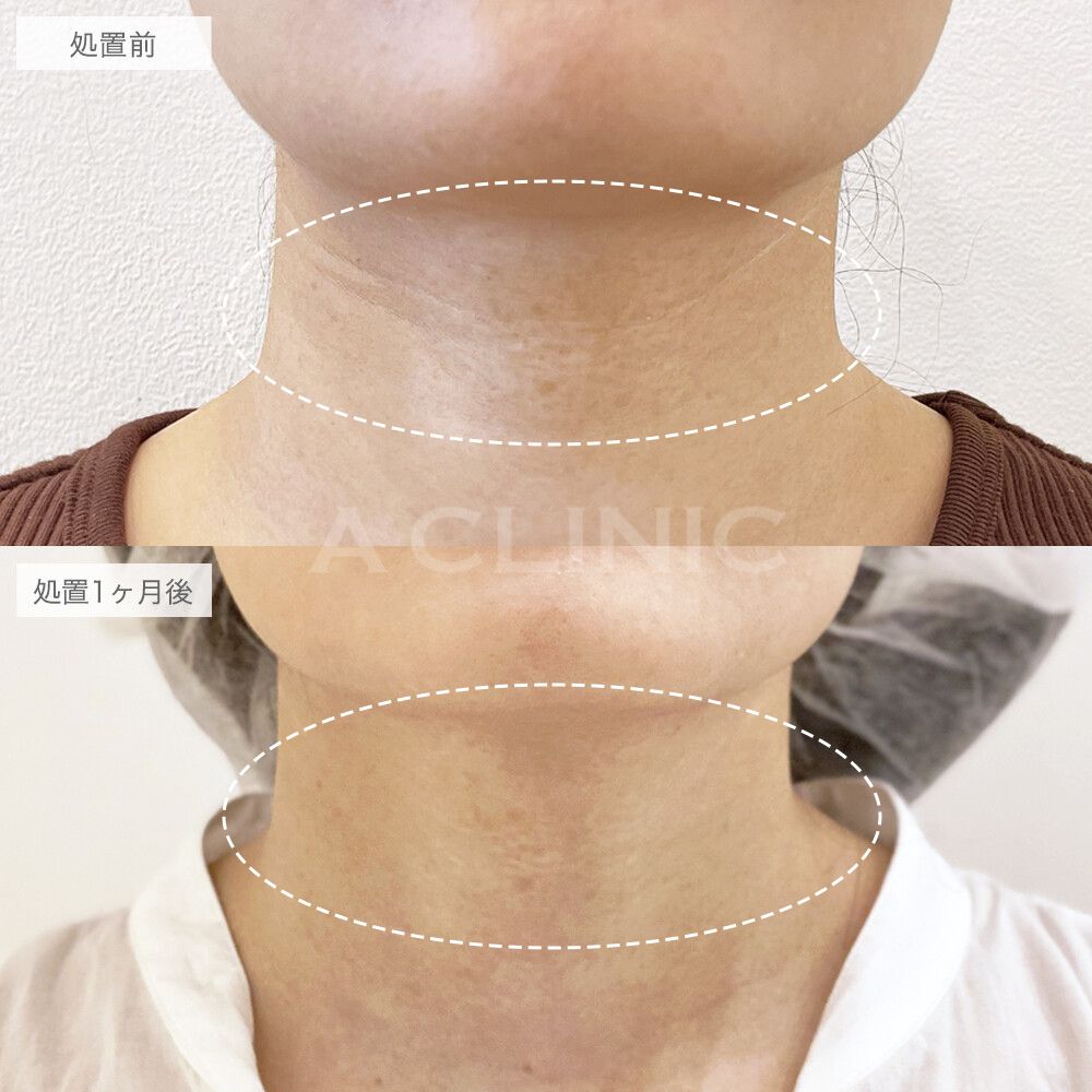 PRP血小板療法症例写真