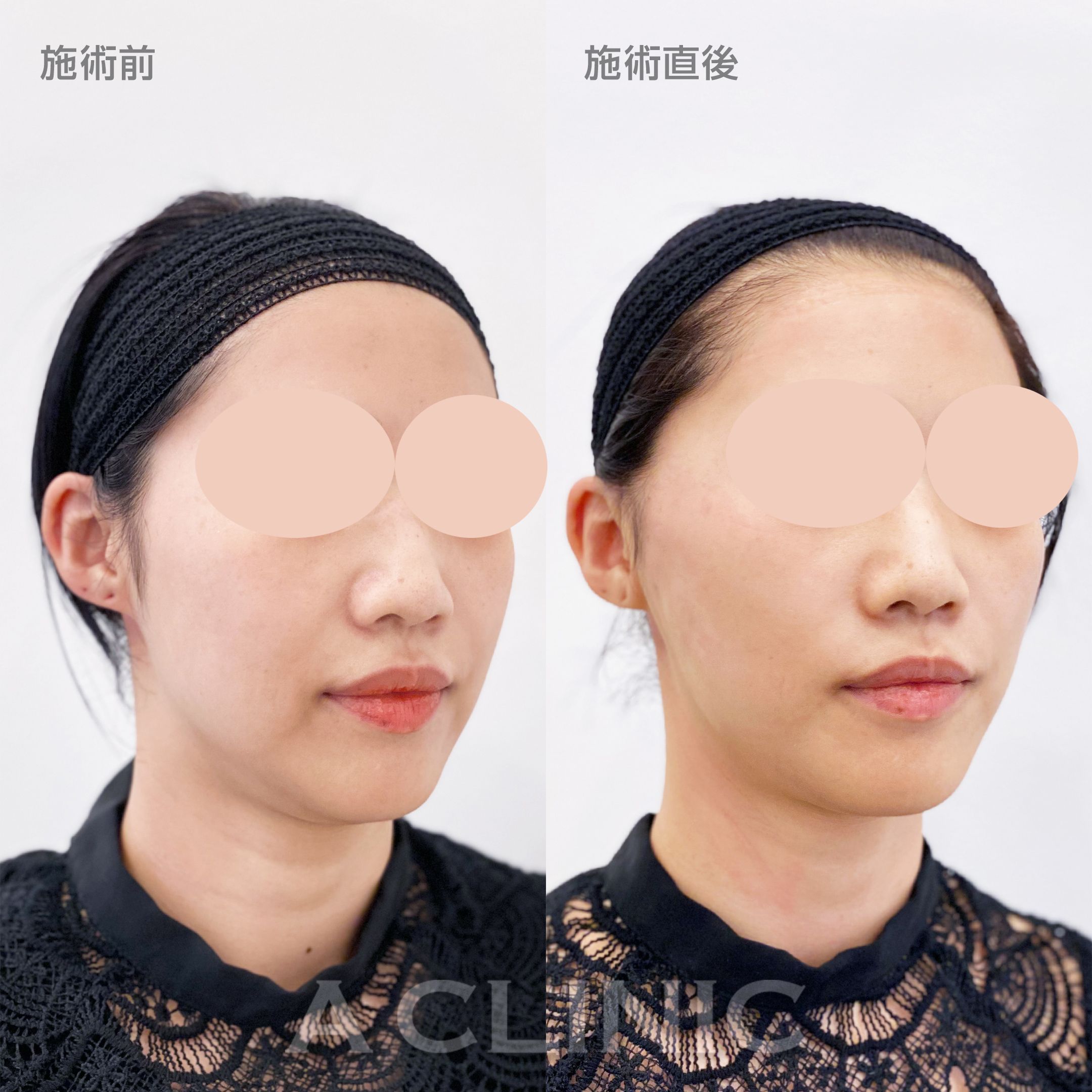 A式美肌たるみ切開症例写真