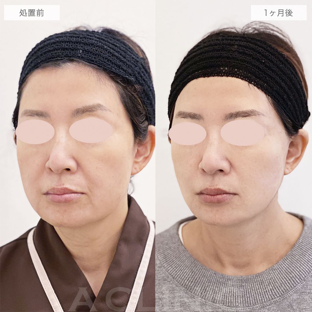 A式美肌たるみ切開症例写真