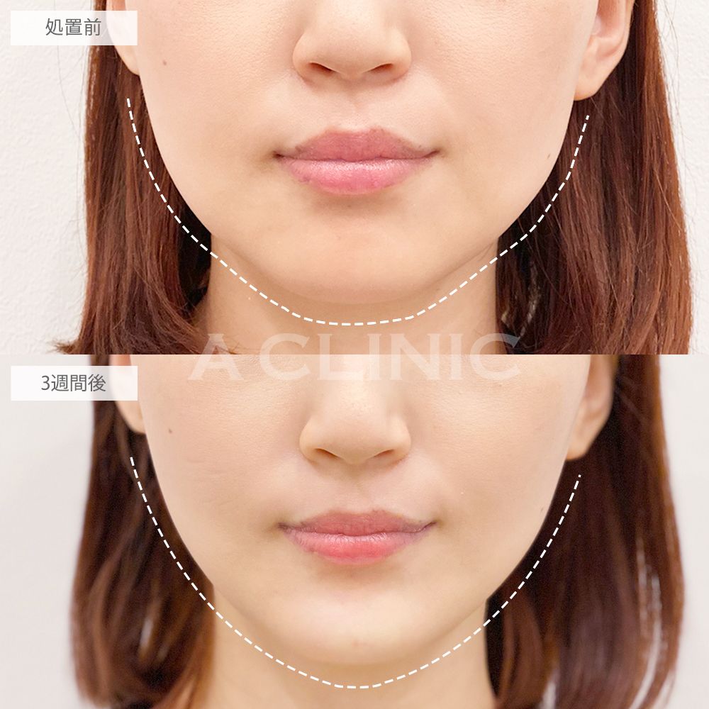いちごフェイス症例写真