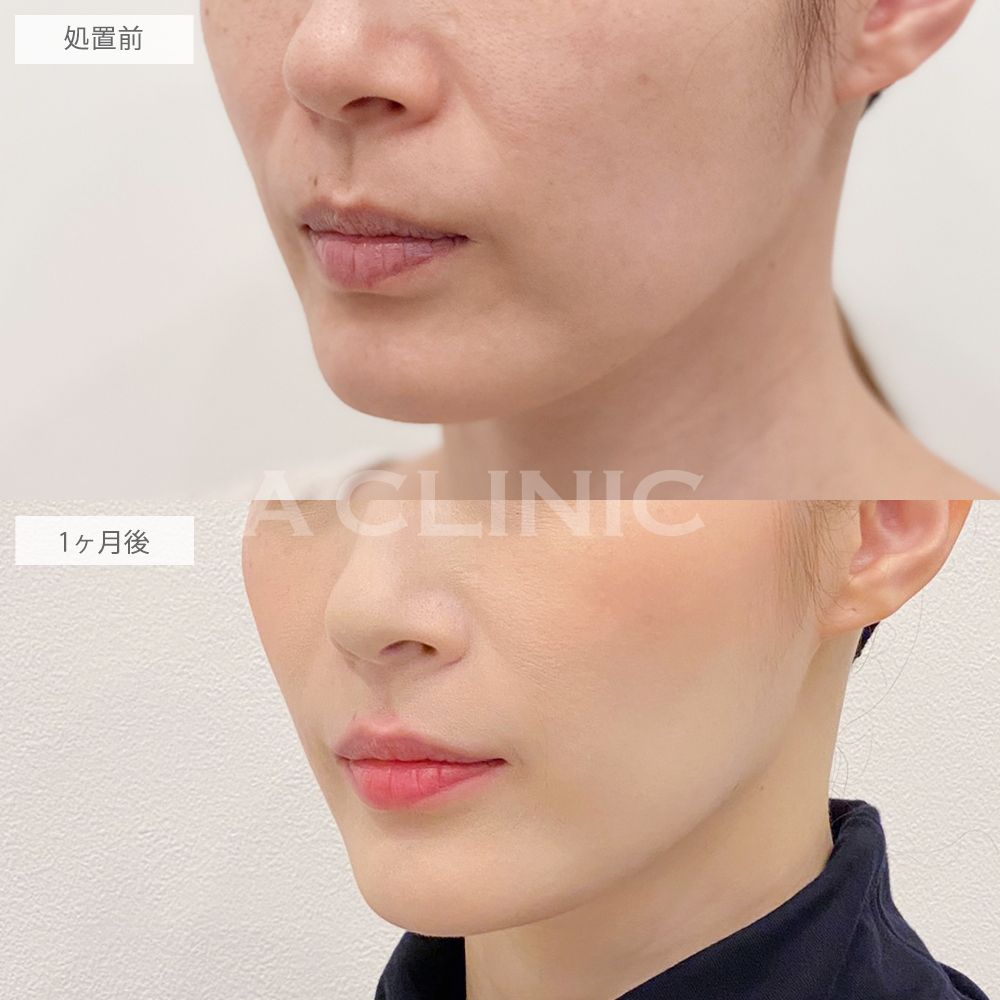 いちごフェイス症例写真