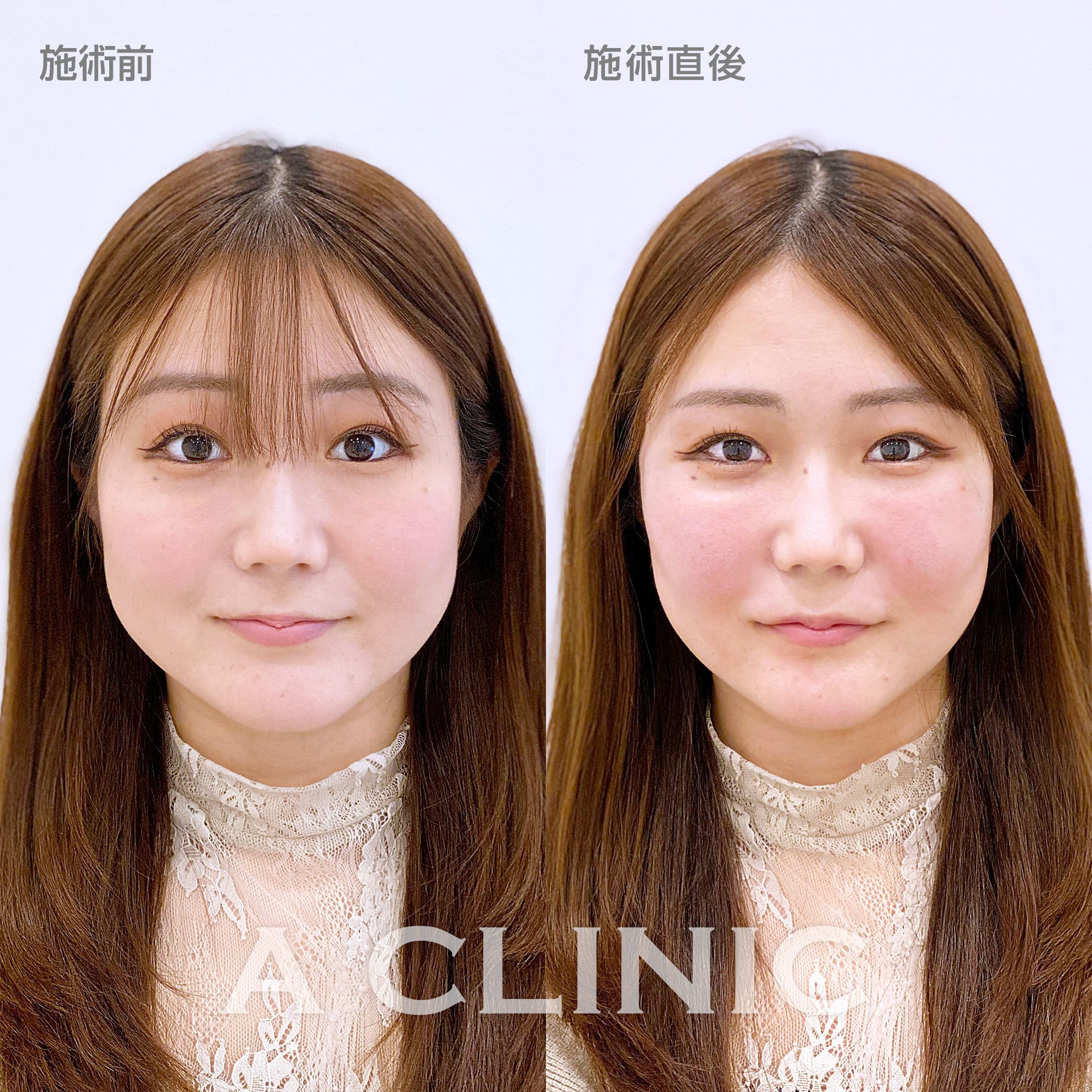 顔の横幅縮小術(脂肪吸引)症例写真