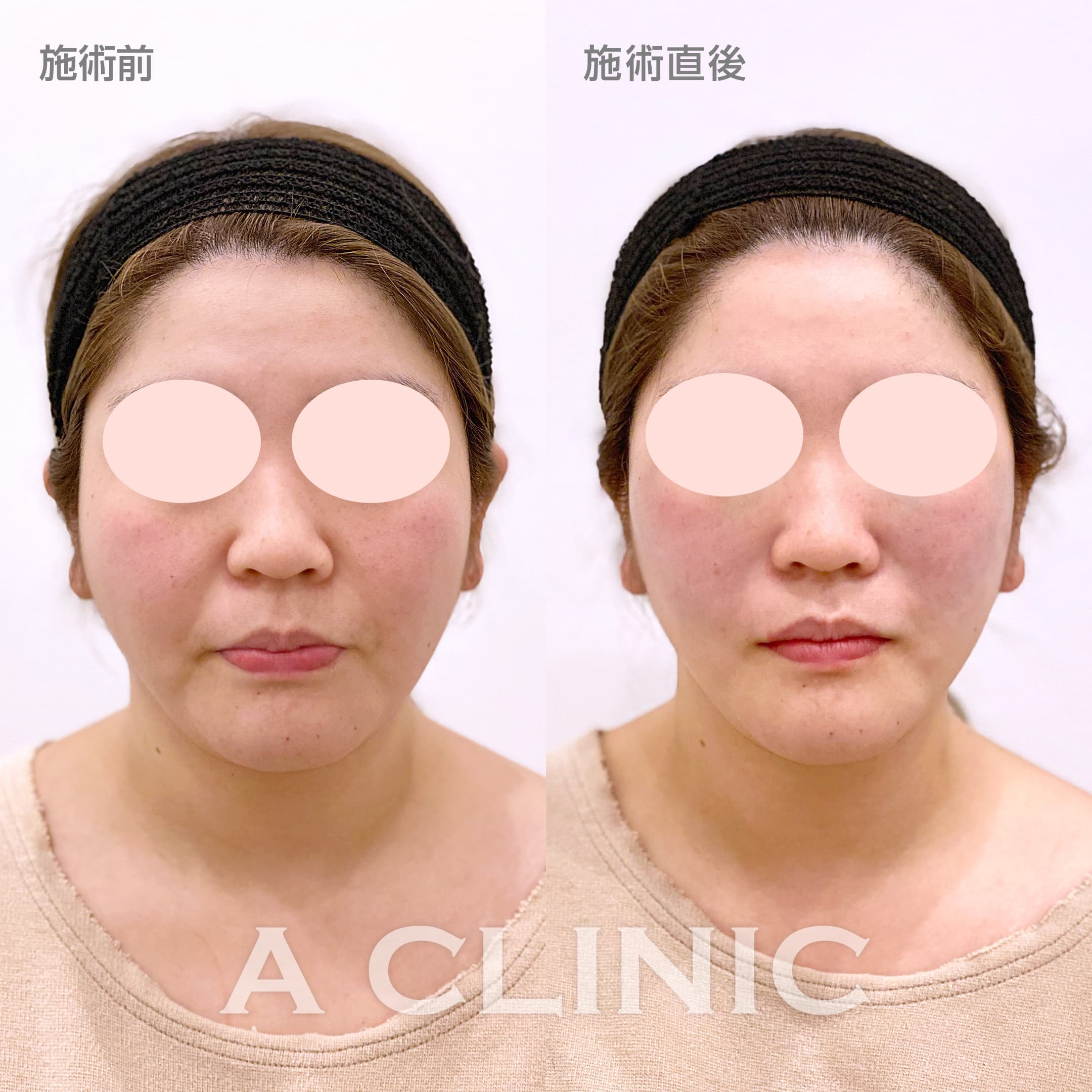 顔の横幅縮小術(脂肪吸引)症例写真