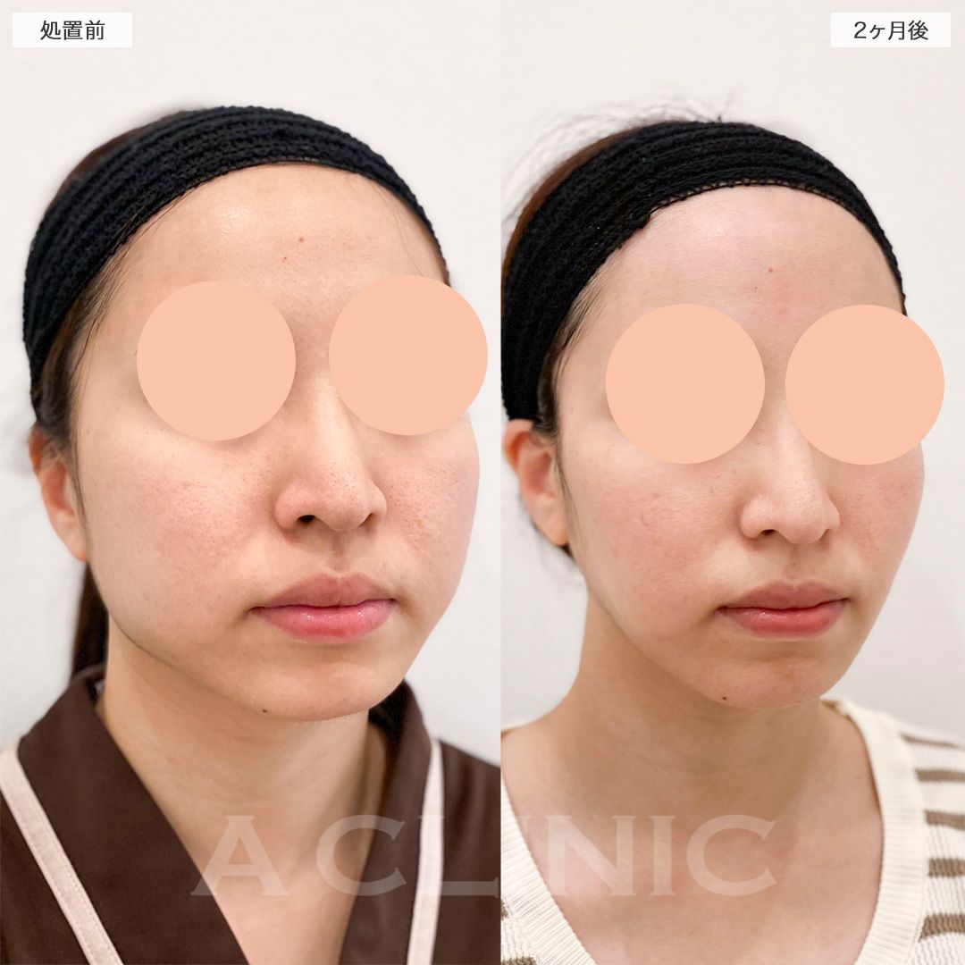 顔の横幅縮小術(脂肪吸引)症例写真