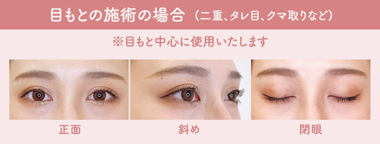 目もとの施術の場合(二重、タレ目、クマ取りなど)