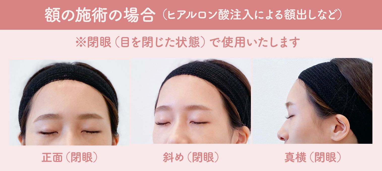 額の施術の場合(ヒアルロン酸注入による額出しなど)