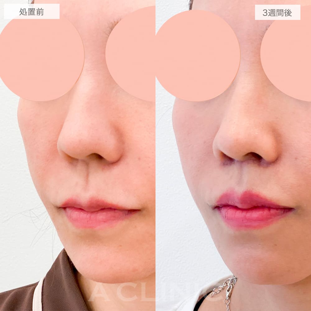 人中短縮術症例