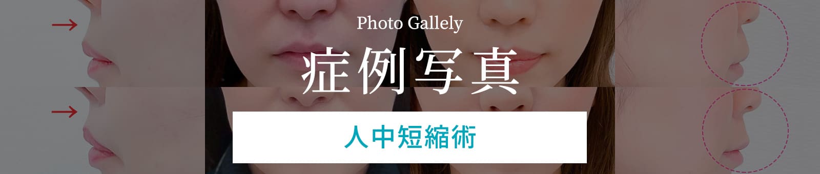 症例写真 人中短縮術