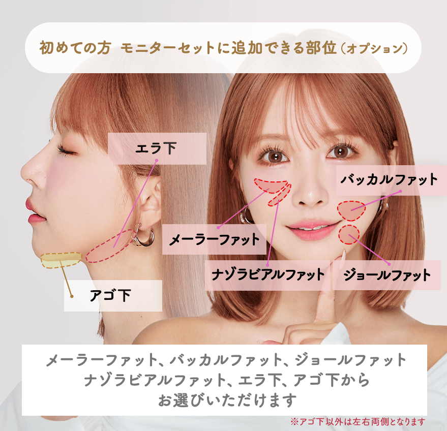 1day小顔脂肪吸引（頬・輪郭・顎下・エラ下・メーラーファット・ジョールファット・ナゾラビアルファット・バッカルファット）の症例モニター募集