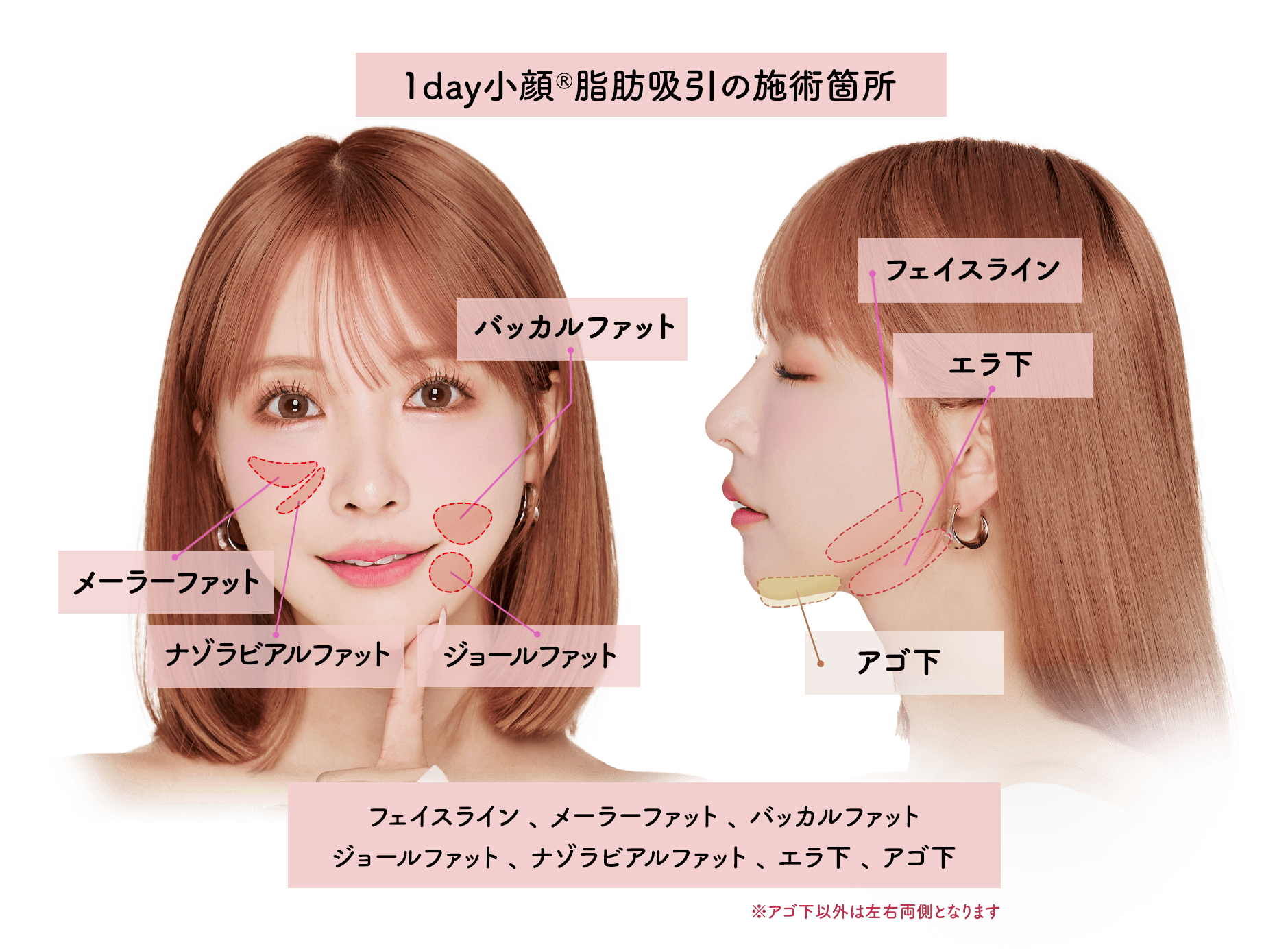 1day小顔脂肪吸引の施術部位