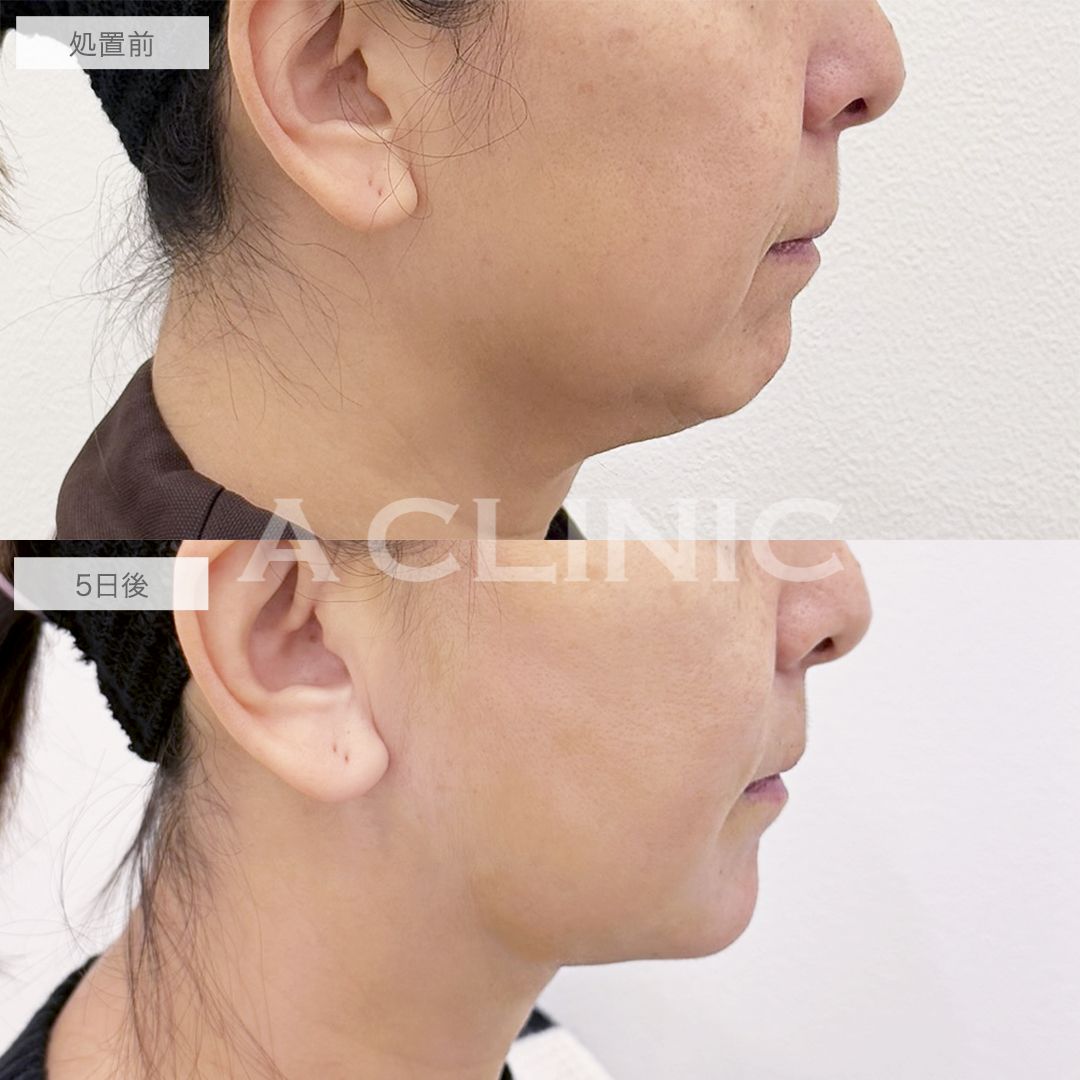 アゴ下へのAスレッド®の症例写真BEFORE AFTER 01