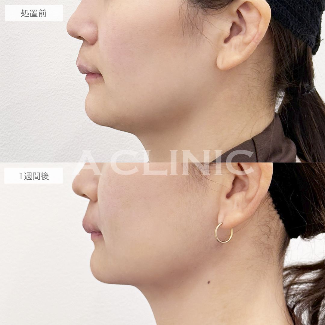 アゴ下へのAスレッド®の症例写真BEFORE AFTER 02