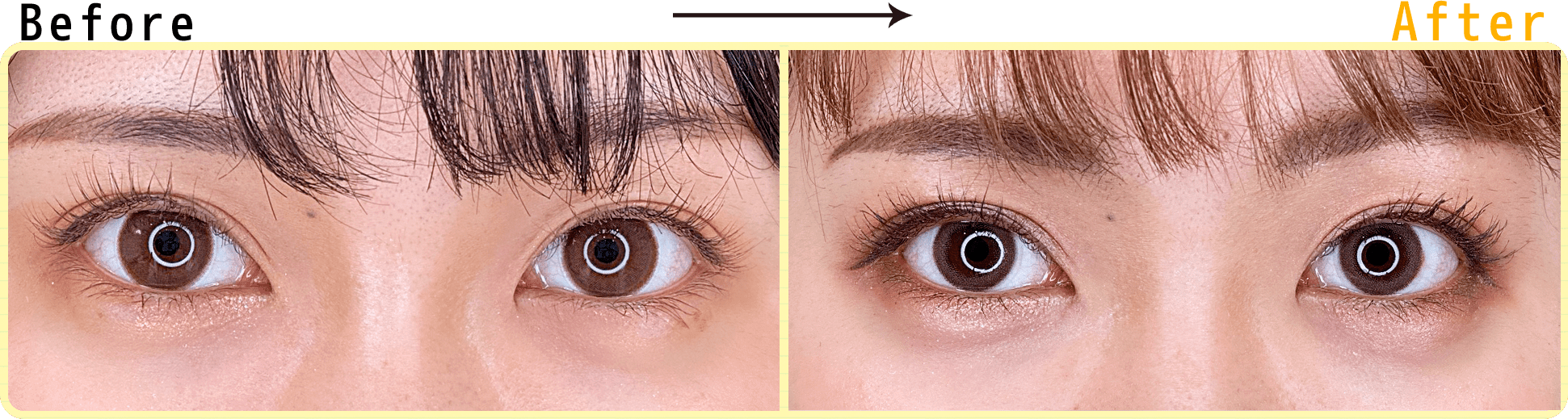 パーフェクトアイズ症例写真6