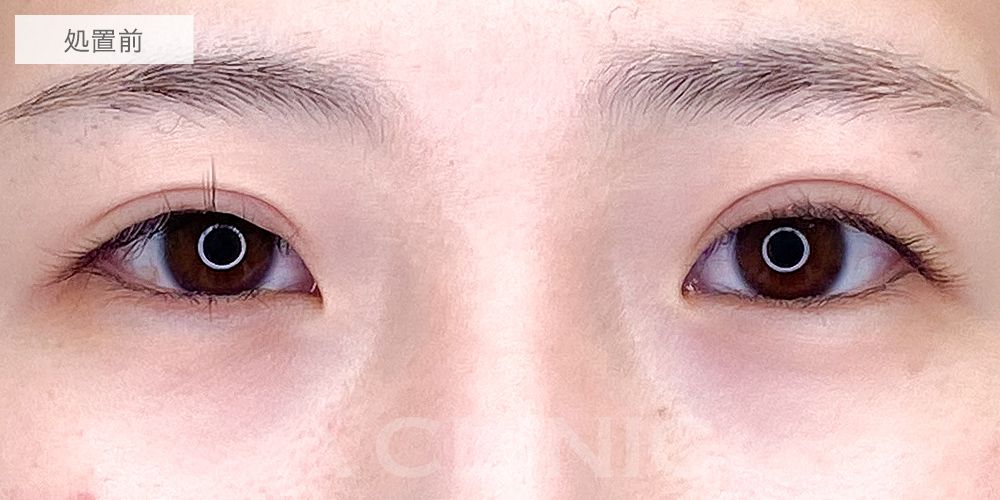 パーフェクトアイズ症例写真8