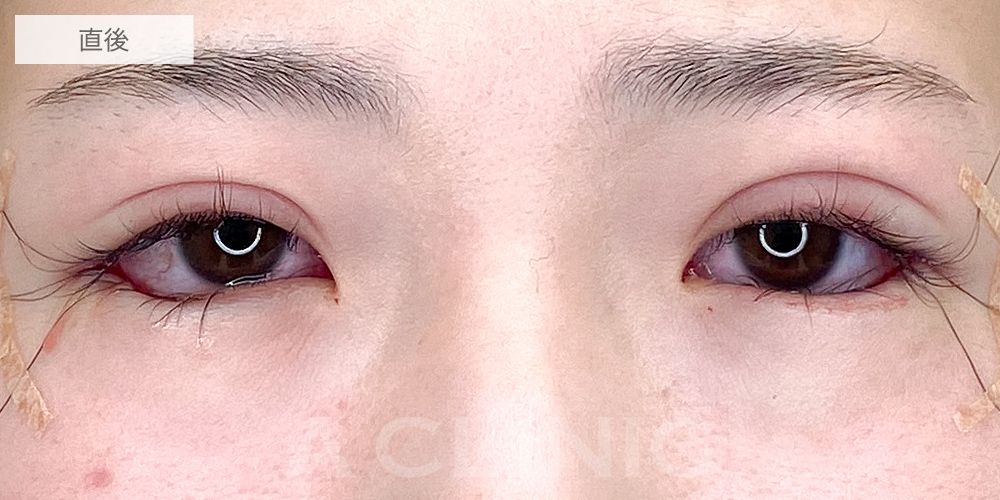 パーフェクトアイズ症例写真9