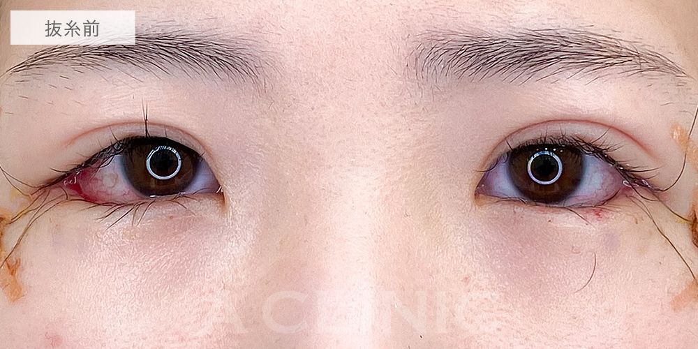 パーフェクトアイズ症例写真10