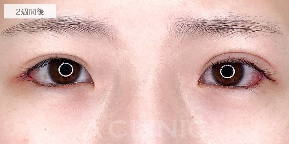 パーフェクトアイズ症例写真12